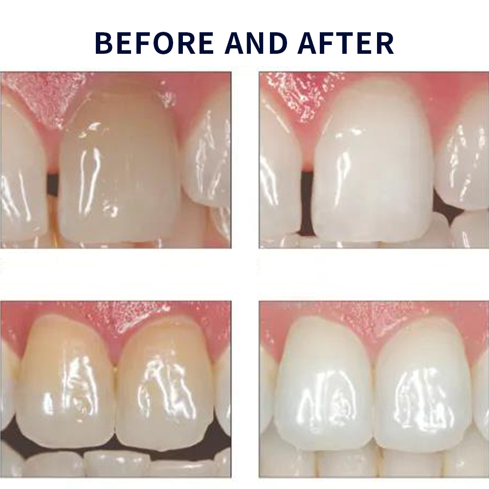 مجموعة جل تبييض أوباليزانس ، م - مراجعة Teeth Whitening Kit At Home وسعره