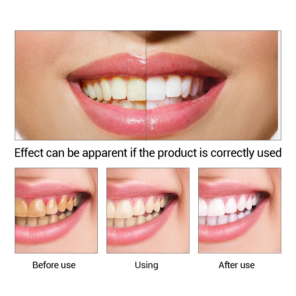 Fteenly تبييض الأسنان جوهر مسح - مراجعة Teeth Whitening Q&M وسعره
