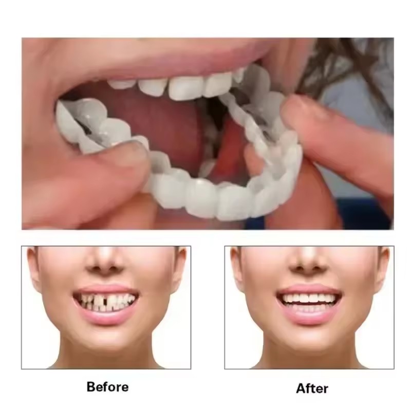 أطقم أسنان اصطناعية مؤقتة لتبي - مراجعة Teeth Whitening Veneers وسعره
