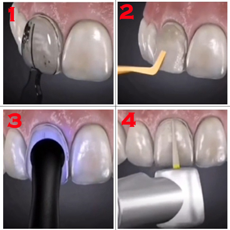 قالب أسنان لقشور الراتنج المرك - مراجعة Teeth Whitening Veneers وسعره