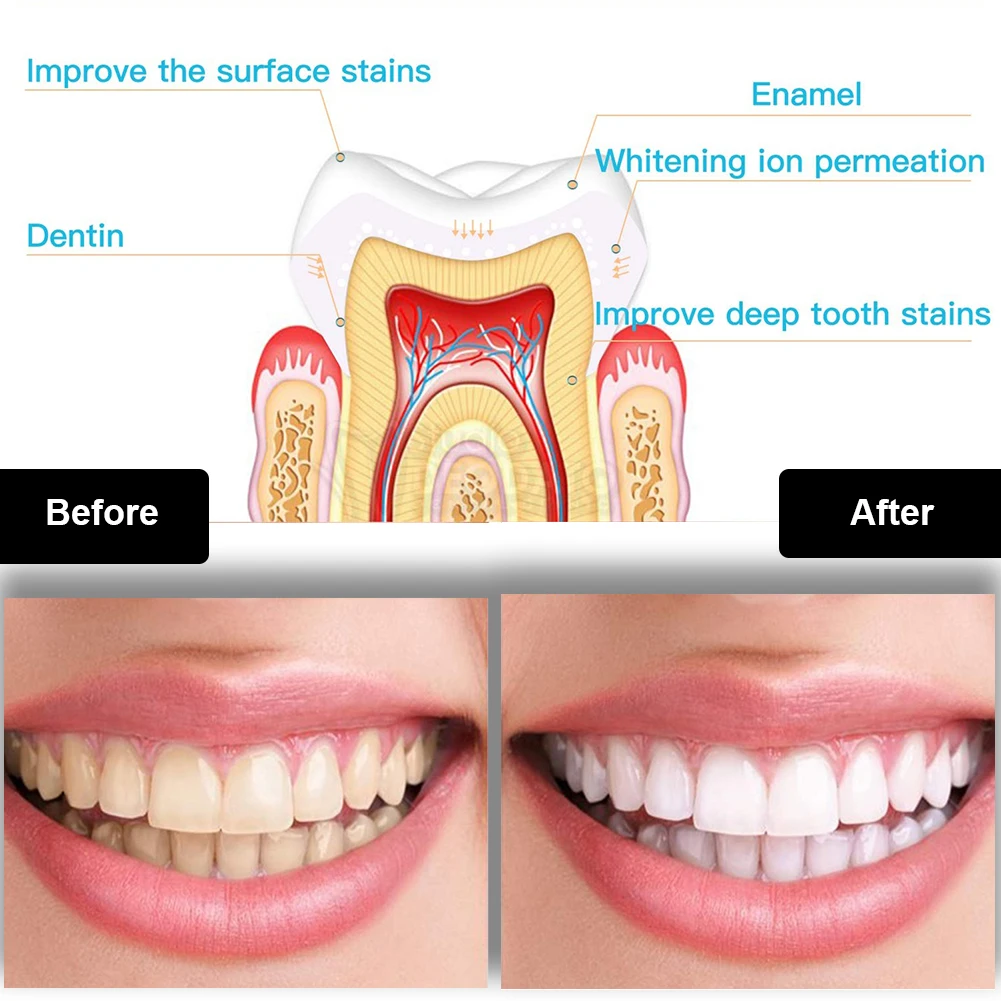 طقم تبييض الأسنان صغير 16 LED  - مراجعة Teeth Whitening With Peroxide وسعره